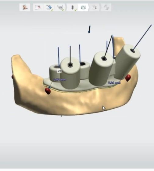 Empowering Dental Clinicians with 3Shape's Implant Studio