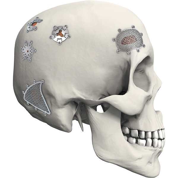 Why Premold Titanium Mesh is Revolutionizing Medical Applications