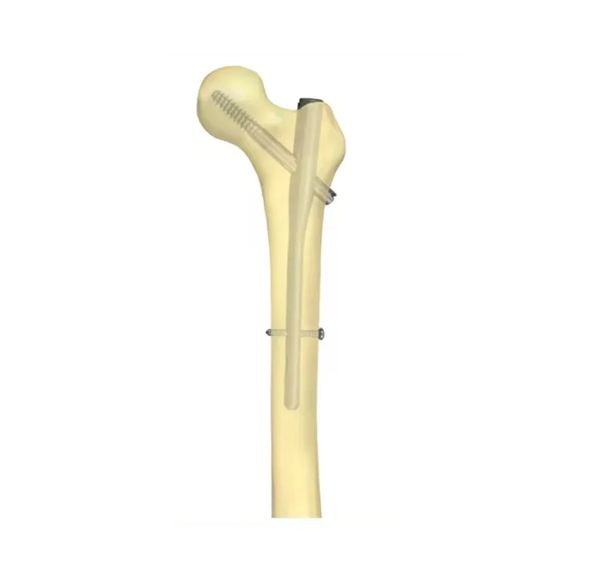 Why Surgeons Prefer Titanium Intramedullary Nails in Modern Orthopedics