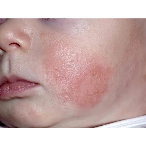 Baby Care Knowledge Popularization_ Common Rashes and Symptoms in Infants