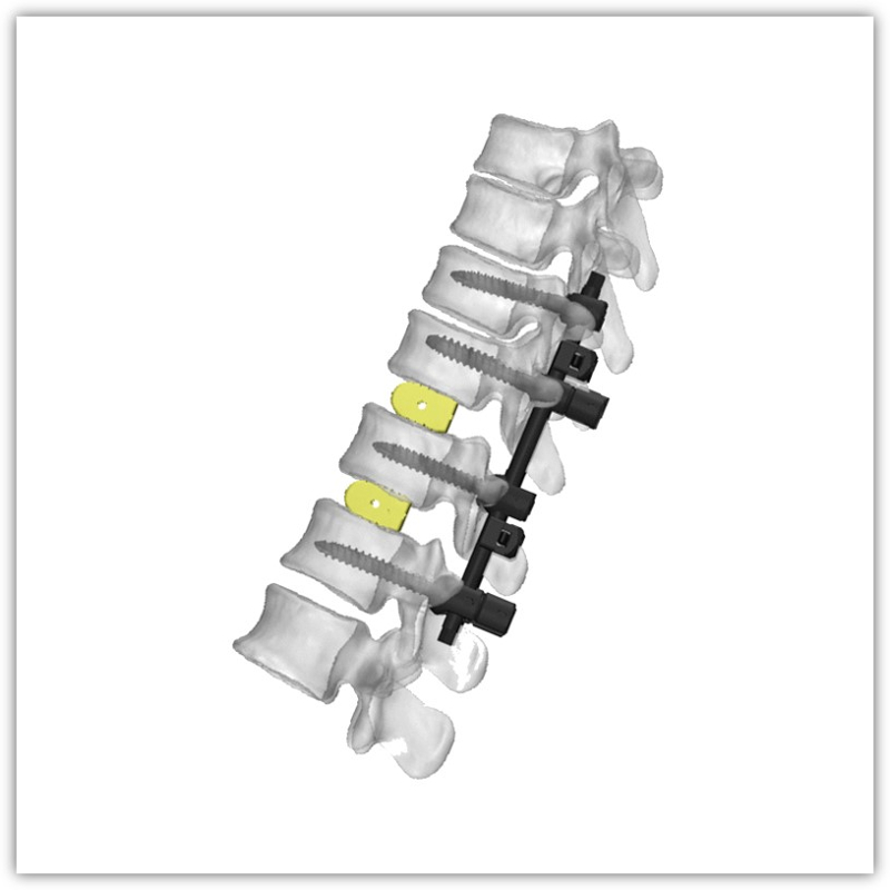 https://okki-shop.oss-cn-hangzhou.aliyuncs.com/category/83036/2966/0fbf9e0eb83f77190ff3c13a761f0d5a/Spinal%20System.jpg