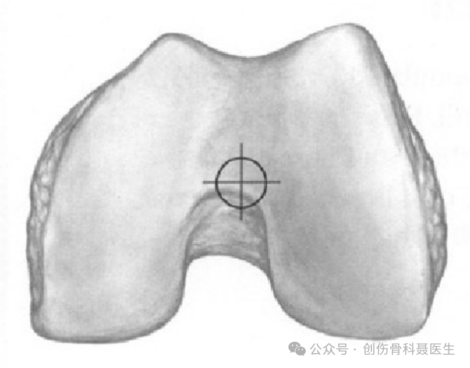 indications and surgical techniques for intramedullary nailing of extremity fractures-8