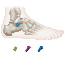 Treatment of ankle joint instability: biomechanics of directional stabilizing screws