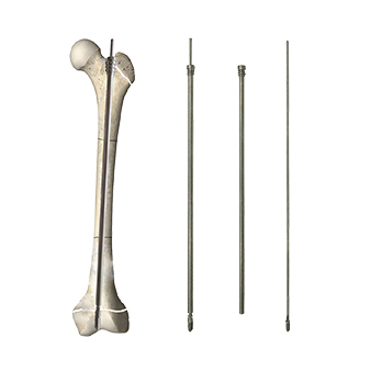 Telescopic Intramedullary Nail