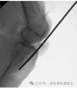 indications and surgical techniques for intramedullary nailing of extremity fractures-5