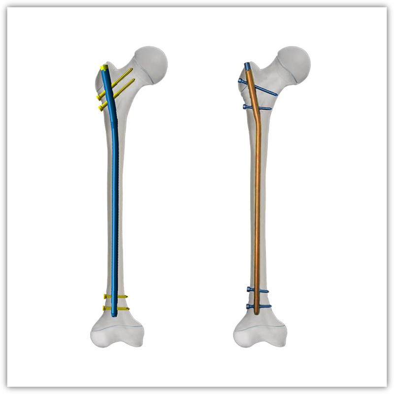 https://okki-shop.oss-cn-hangzhou.aliyuncs.com/category/83036/2966/b4f55fe6234833f8f28eedbd3752b5c5/Intramedullary%20Pin%26Nail.jpg