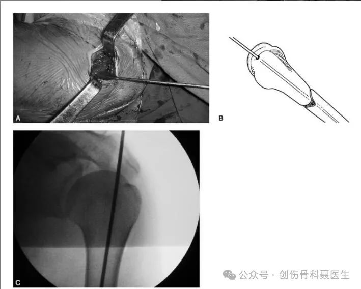 indications and surgical techniques for intramedullary nailing of extremity fractures-1